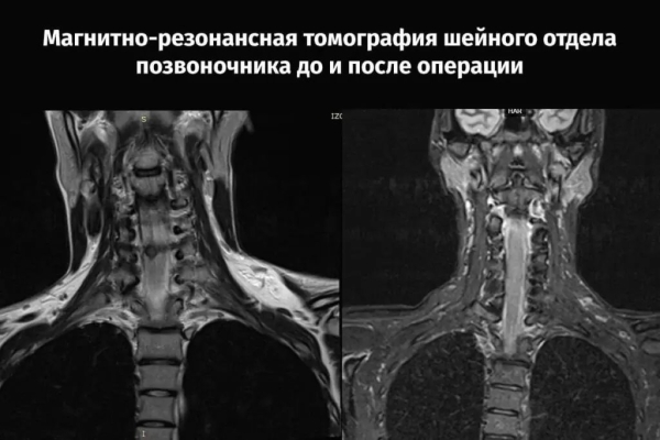 В Беларуси впервые провели операцию на позвоночнике с отечественным имплантатом
